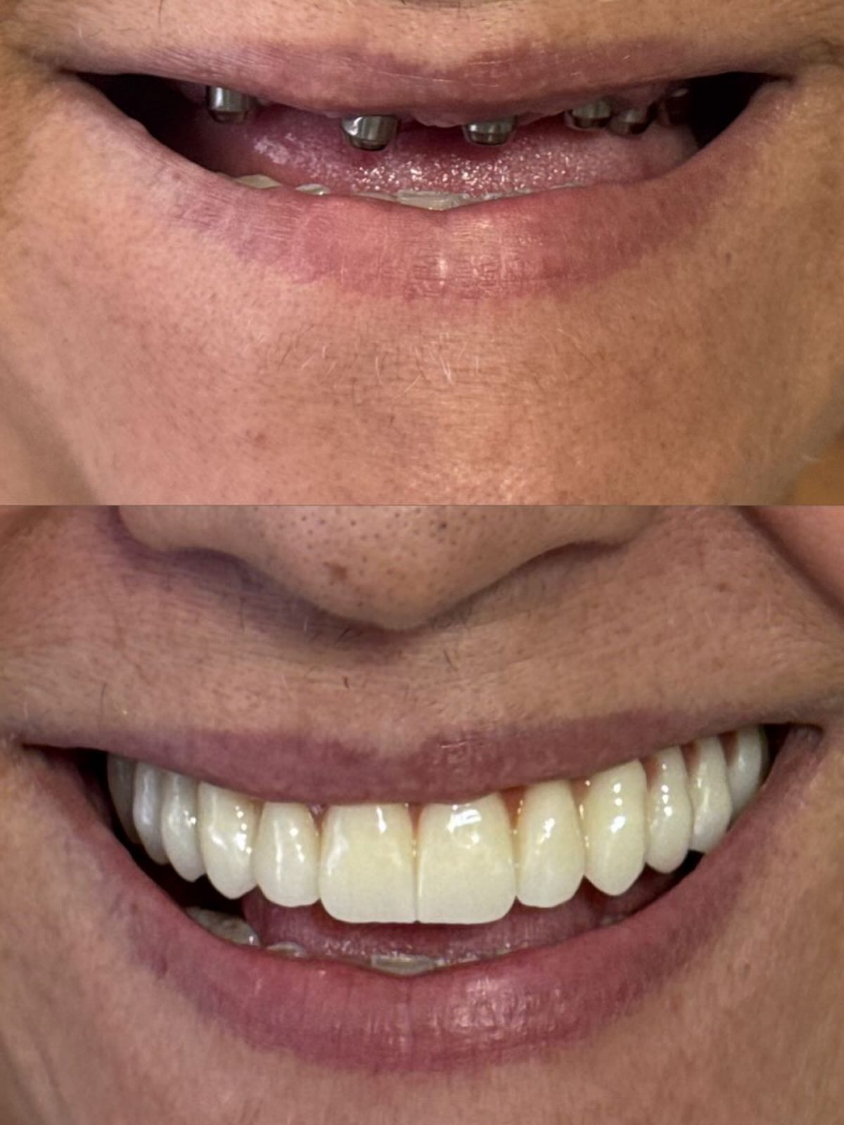 Implantes Dentários